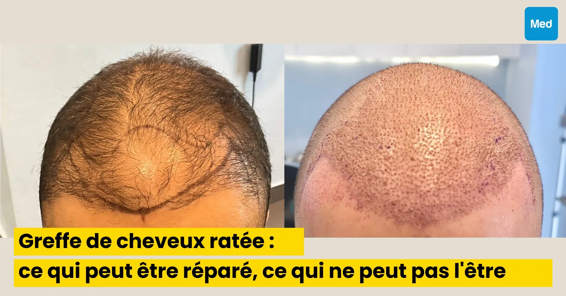 Greffe de cheveux ratée : ce qui peut être réparé, ce qui ne peut pas l'être